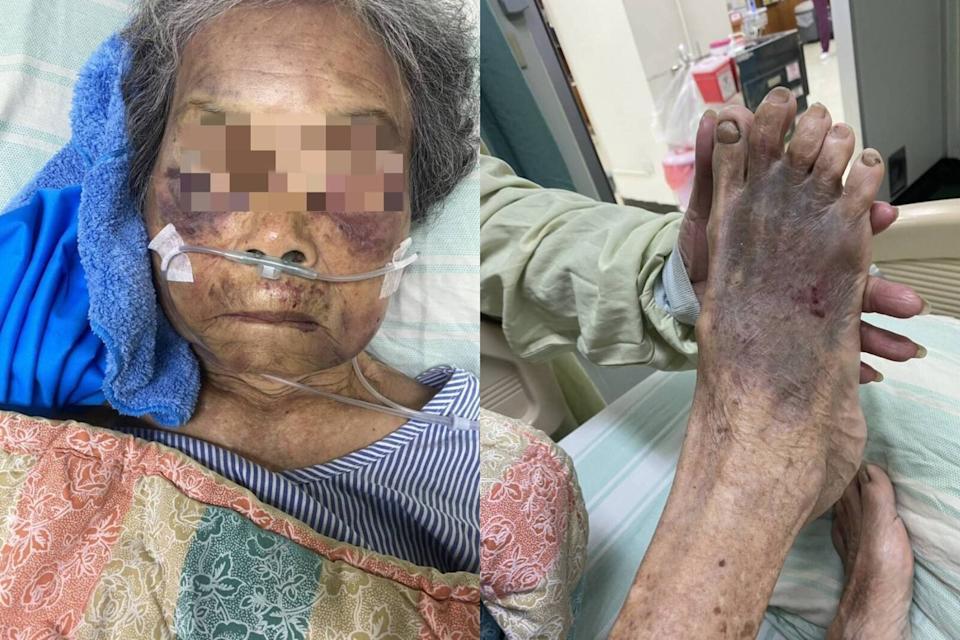 惡孫討錢不成痛毆90歲阿嬤！腦出血送ICU　屏東警方介入偵辦